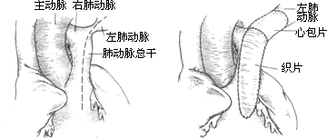 法乐四联症