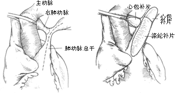 法乐四联症