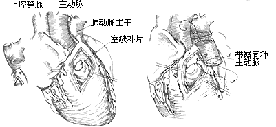 法乐四联症