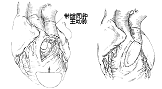 法乐四联症