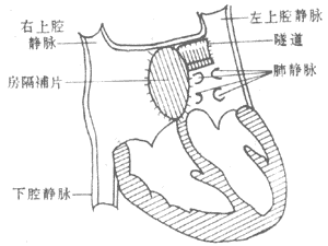 单心房