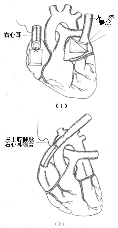 单心房