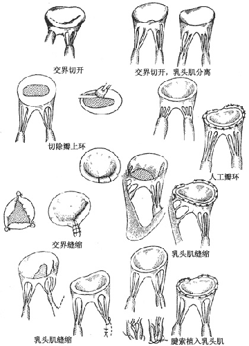 先天性二尖瓣畸形