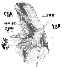 法乐四联症