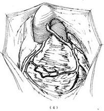 冠状动脉异位起源