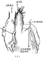 冠状动脉异位起源