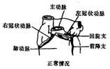 冠状动脉异位起源