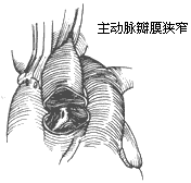 主动脉瓣膜部狭窄
