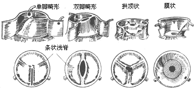 主动脉瓣膜部狭窄