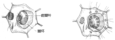 三尖瓣下移畸形