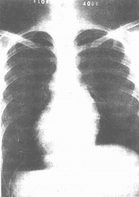 肺动脉口狭窄