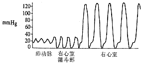 肺动脉口狭窄