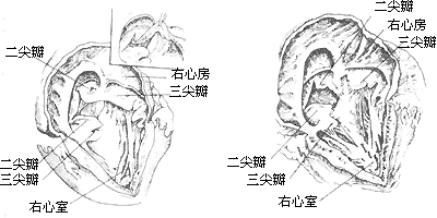 房室管畸形