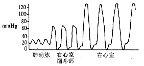 肺动脉口狭窄