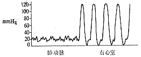 肺动脉口狭窄