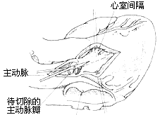 先天性主动脉瓣下狭窄