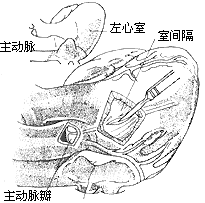 先天性主动脉瓣下狭窄