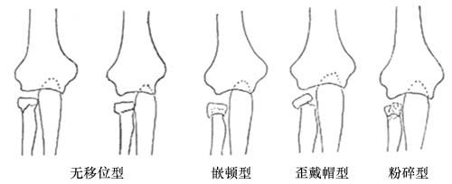 桡骨颈骨折