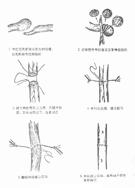 周围神经损伤