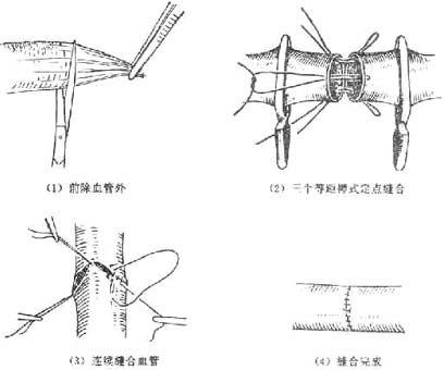 四肢血管损伤