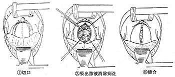 脊椎结核