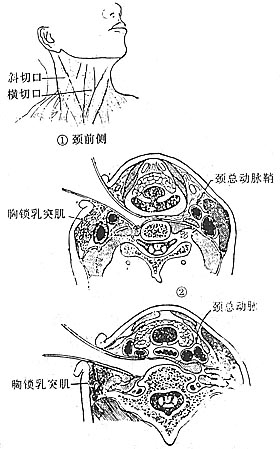 脊椎结核