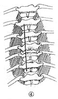 脊椎结核
