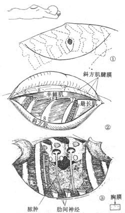 脊椎结核