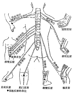 脊椎结核并发截瘫