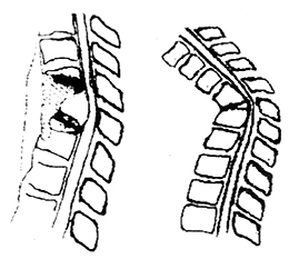 脊椎结核并发截瘫