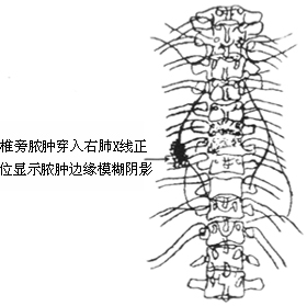 胸椎结核椎旁脓肿穿入肺腔