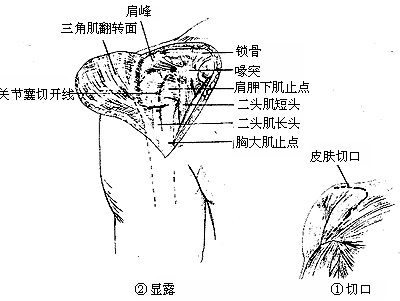 肩关节结核