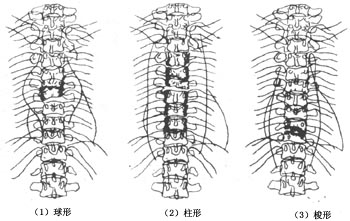 脊椎结核