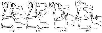 创伤性枢椎前滑脱