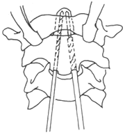 枢椎齿状突骨折