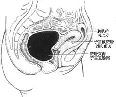 急性输卵管卵巢炎