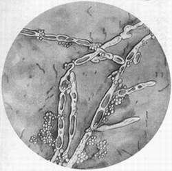 霉菌性外阴炎