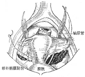 盆腔淤血综合征