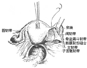 盆腔淤血综合征