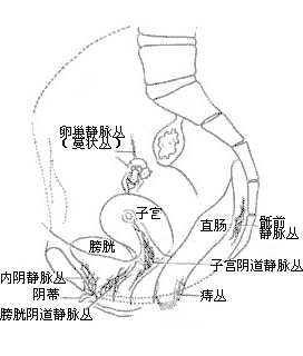 盆腔淤血综合征