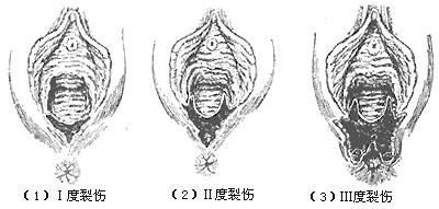 产后出血