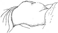 子宫破裂