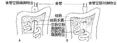 贲门癌