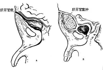 脐尿管囊肿及脐尿管瘘