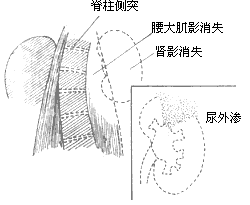 肾损伤