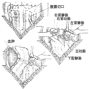 肾损伤