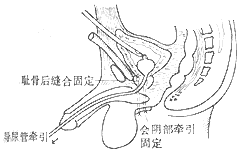 尿道损伤