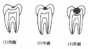 龋病