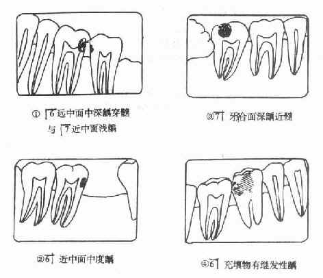 龋病