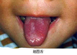 舌病